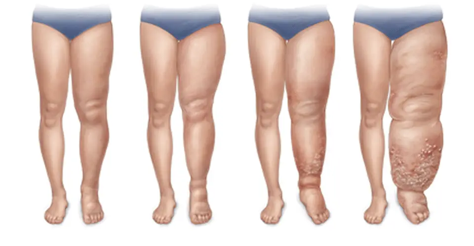 Linfedema e lipedema: top 5 delle terapie più efficaci e innovative %linfedema e lipedema: top 5 delle terapie più efficaci e innovativecount(title)% Linfedema e lipedema: top 5 delle terapie più efficaci e innovative