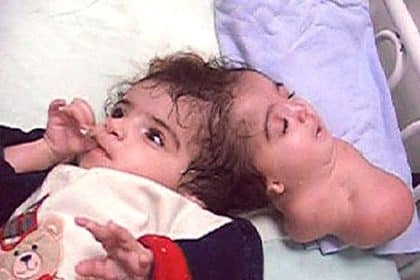 Manar maged: la tragica storia della bambina nata con 2 teste -foto