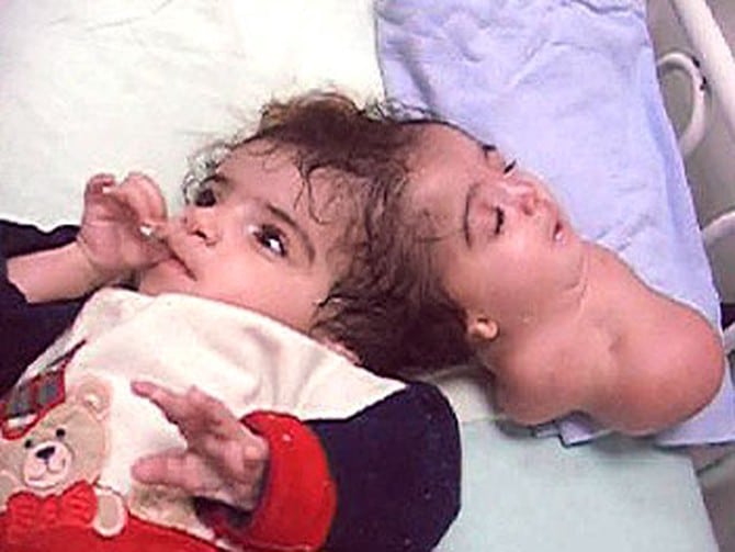 Manar maged: la tragica storia della bambina nata con 2 teste -foto %manar maged: la tragica storia della bambina nata con 2 teste -fotocount(title)% Manar maged: la tragica storia della bambina nata con 2 teste -foto