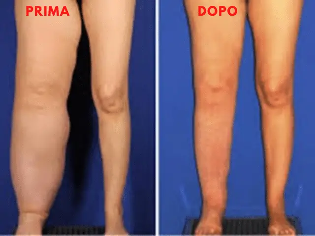Linfedema e lipedema: top 5 delle terapie più efficaci e innovative %linfedema e lipedema: top 5 delle terapie più efficaci e innovativecount(title)% Linfedema e lipedema: top 5 delle terapie più efficaci e innovative