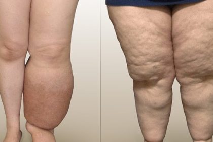 Linfedema e lipedema: top 5 delle terapie più efficaci e innovative