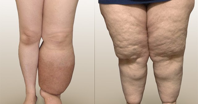 Linfedema e lipedema: top 5 delle terapie più efficaci e innovative %linfedema e lipedema: top 5 delle terapie più efficaci e innovativecount(title)% Linfedema e lipedema: top 5 delle terapie più efficaci e innovative