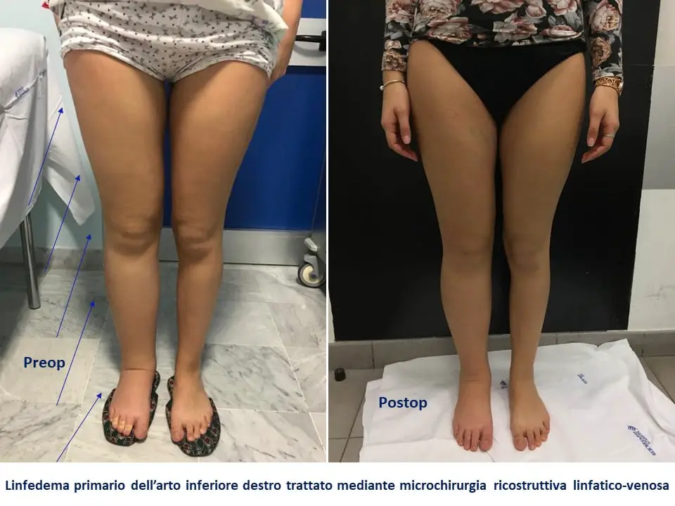 Linfedema e lipedema: top 5 delle terapie più efficaci e innovative %linfedema e lipedema: top 5 delle terapie più efficaci e innovativecount(title)% Linfedema e lipedema: top 5 delle terapie più efficaci e innovative