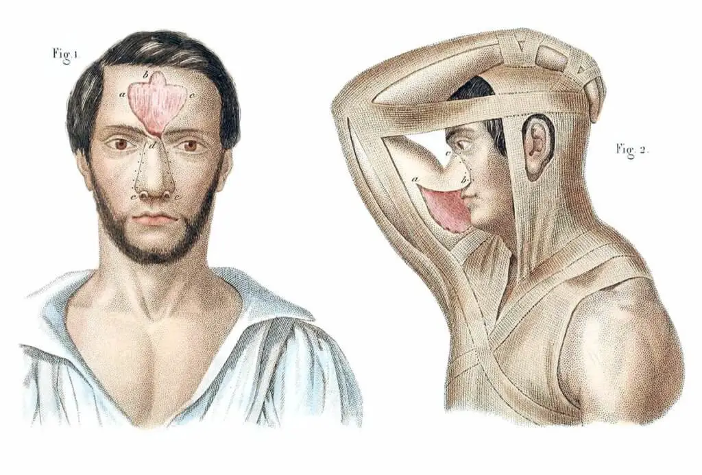 Gaspare tagliacozzi: quando la rinoplastica nel '500 richiedeva settimane di torture fisiche -immagini %gaspare tagliacozzi: quando la rinoplastica nel '500 richiedeva settimane di torture fisiche -immaginicount(title)% Gaspare tagliacozzi: quando la rinoplastica nel '500 richiedeva settimane di torture fisiche -immagini