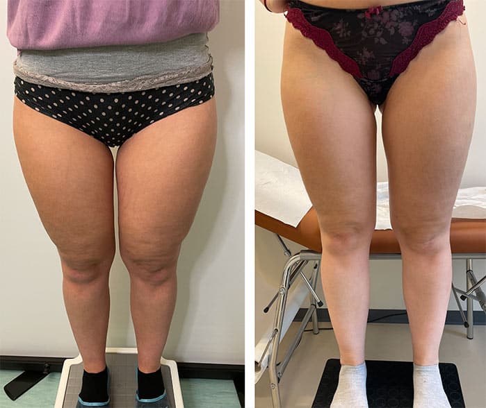 Linfedema e lipedema: top 5 delle terapie più efficaci e innovative %linfedema e lipedema: top 5 delle terapie più efficaci e innovativecount(title)% Linfedema e lipedema: top 5 delle terapie più efficaci e innovative