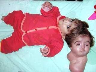 Manar maged: la tragica storia della bambina nata con 2 teste -foto %manar maged: la tragica storia della bambina nata con 2 teste -fotocount(title)% Manar maged: la tragica storia della bambina nata con 2 teste -foto