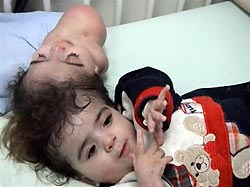 Manar maged: la tragica storia della bambina nata con 2 teste -foto %manar maged: la tragica storia della bambina nata con 2 teste -fotocount(title)% Manar maged: la tragica storia della bambina nata con 2 teste -foto
