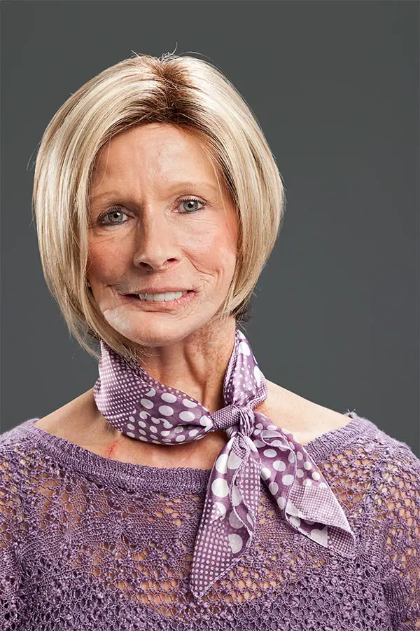 Terrie linn mcnutt hall, l'orrore del fumo iniziato a 17 anni: 11 tumori e un viso sfigurato da 48 interventi- foto