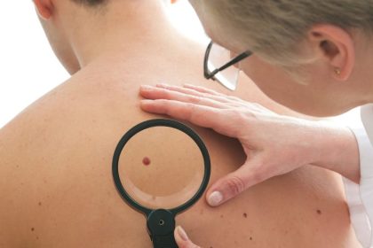 Guida al controllo dei nei: ecco come tenerli sott'occhio e capire quando preoccuparsi