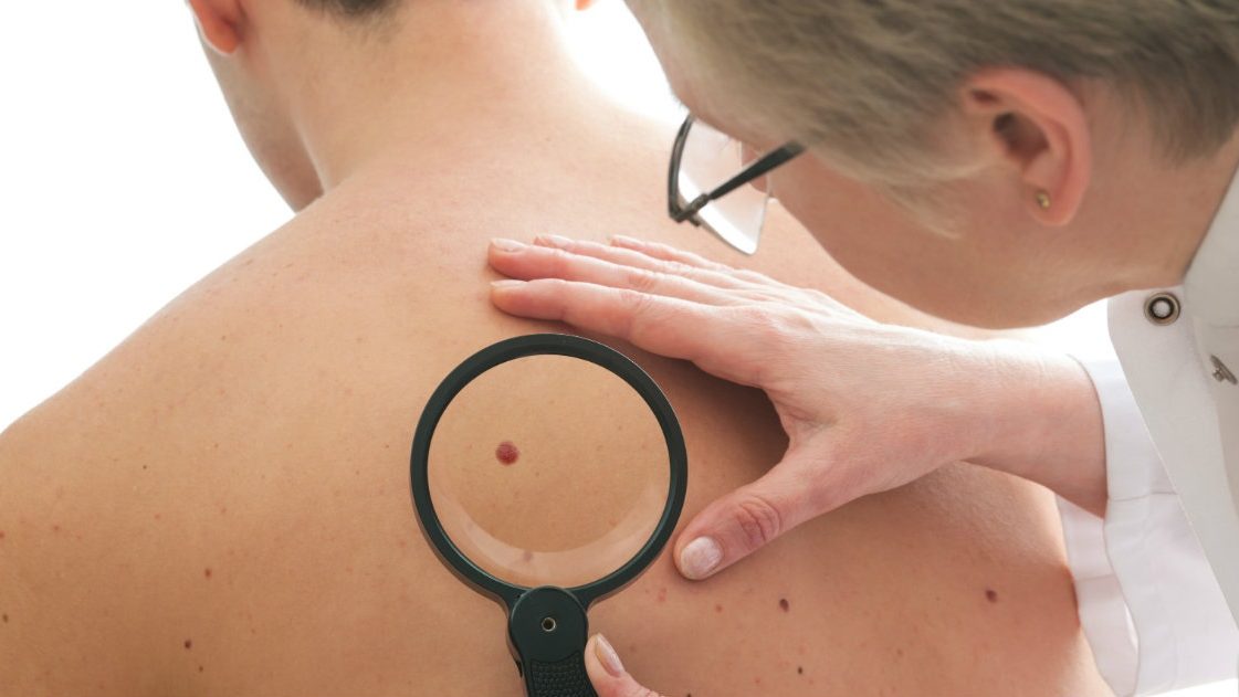 Guida al controllo dei nei: ecco come tenerli sott'occhio e capire quando preoccuparsi