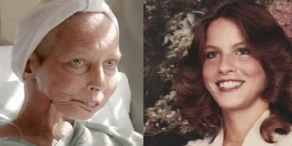 Terrie linn mcnutt hall, l'orrore del fumo iniziato a 17 anni: 11 tumori e un viso sfigurato da 48 interventi- foto