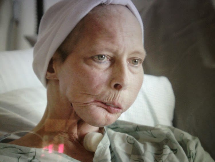Terrie linn mcnutt hall, l'orrore del fumo iniziato a 17 anni: 11 tumori e un viso sfigurato da 48 interventi- foto