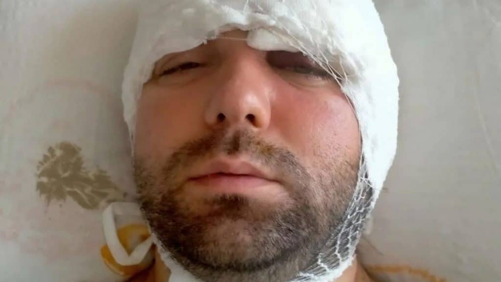 Ramazan yilmaz: l'uomo che ha quasi perso la vita a causa di un impianto dentale approssimativo - foto