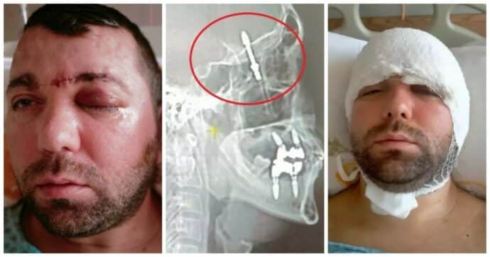 Ramazan yilmaz: l'uomo che ha quasi perso la vita a causa di un impianto dentale approssimativo - foto