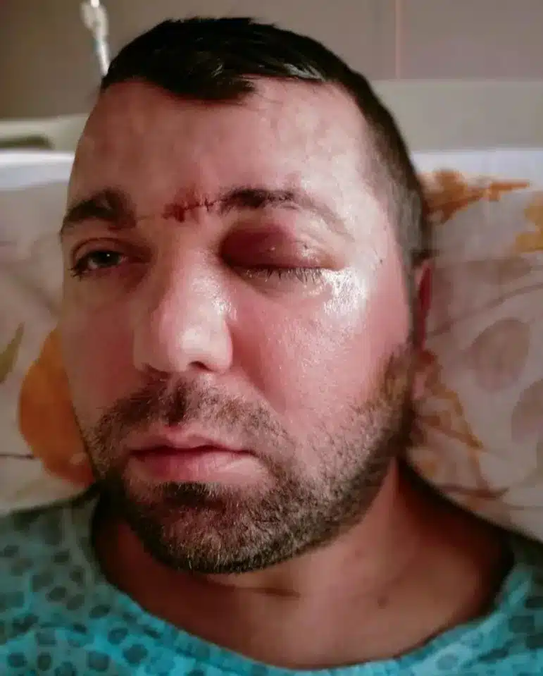 Ramazan yilmaz: l'uomo che ha quasi perso la vita a causa di un impianto dentale approssimativo - foto