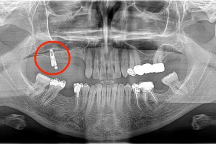 Ramazan yilmaz: l'uomo che ha quasi perso la vita a causa di un impianto dentale approssimativo - foto