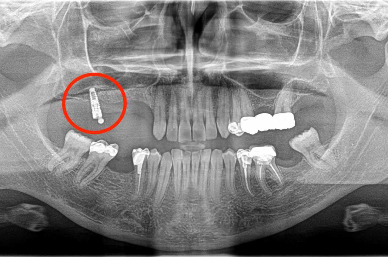 Ramazan yilmaz: l'uomo che ha quasi perso la vita a causa di un impianto dentale approssimativo - foto