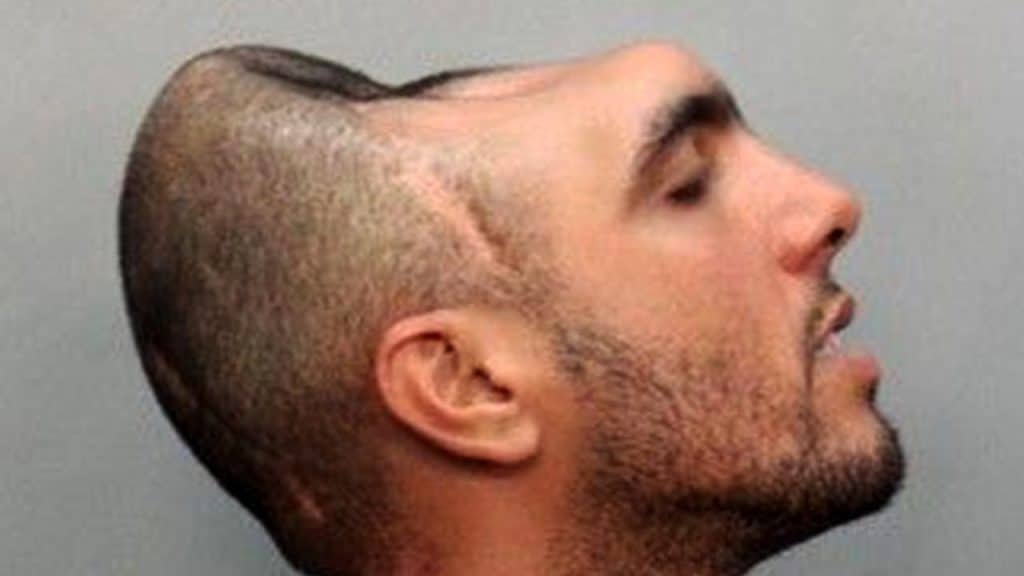 Carlos rodríguez detto "halfy": l'uomo com mezza testa -foto