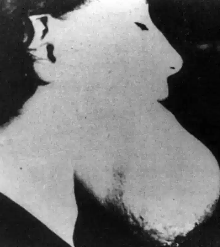 Radium girls: reclutate per un lavoro prestigioso, pagato con un volto sfigurato - foto