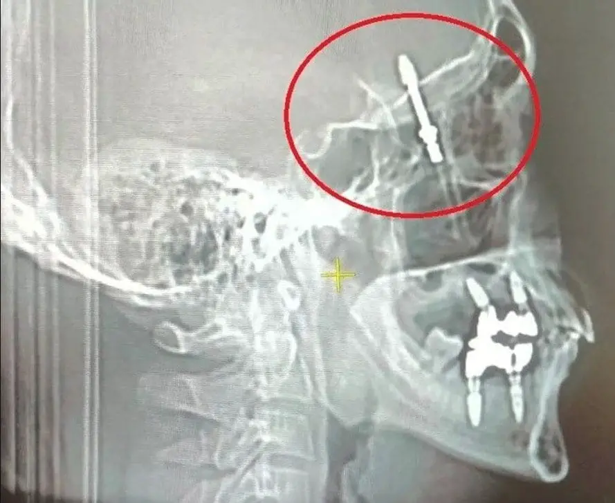Ramazan yilmaz: l'uomo che ha quasi perso la vita a causa di un impianto dentale approssimativo - foto