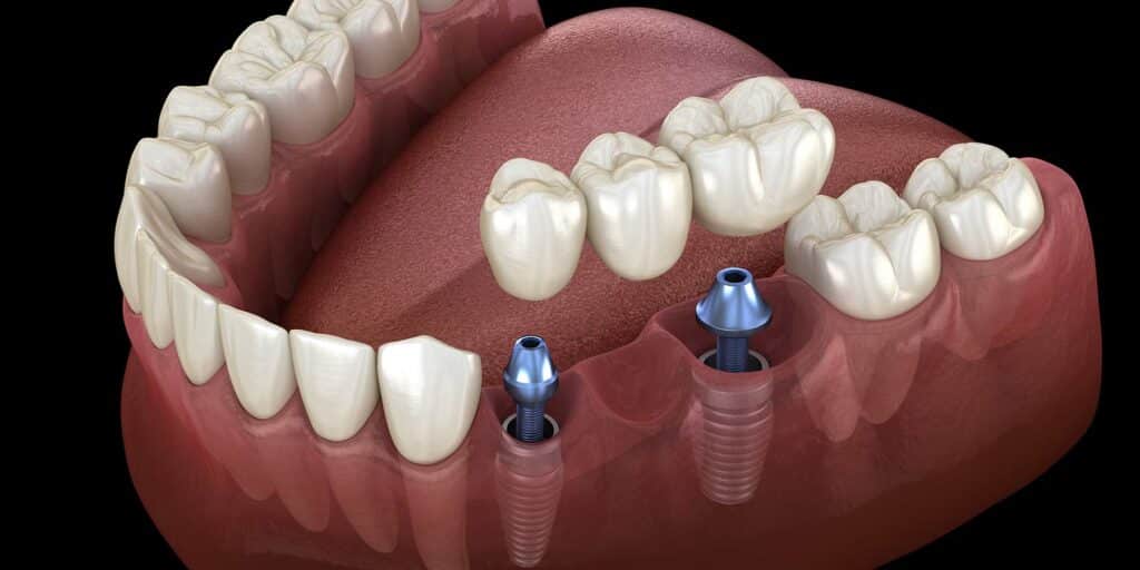 Ramazan yilmaz: l'uomo che ha quasi perso la vita a causa di un impianto dentale approssimativo - foto