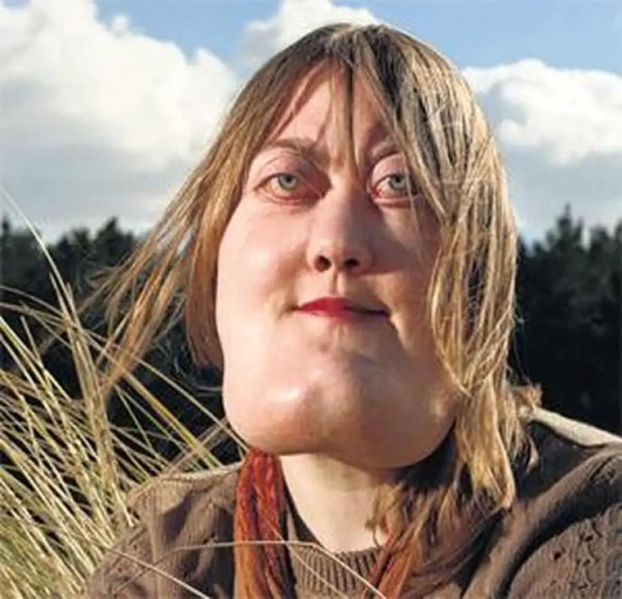 Victoria wright: un volto deturpato dal cherubismo, una vita di abusi e la voglia di aiutare gli altri - foto