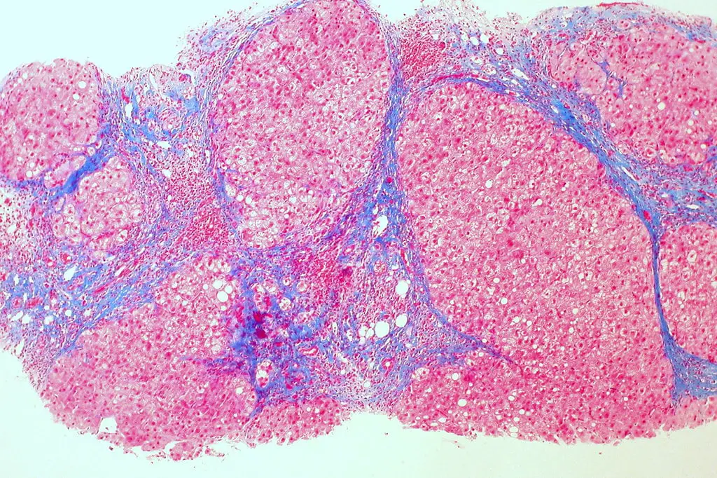 Una semplice analisi del sangue può prevedere il rischio di gravi malattie al fegato: lo dice uno studio svedese