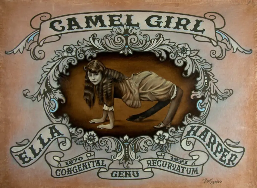 Ella harper: la "ragazza cammello" affetta da genu recurvatum, sfruttata e disumanizzata per compiacere il pubblico dei freak show - foto