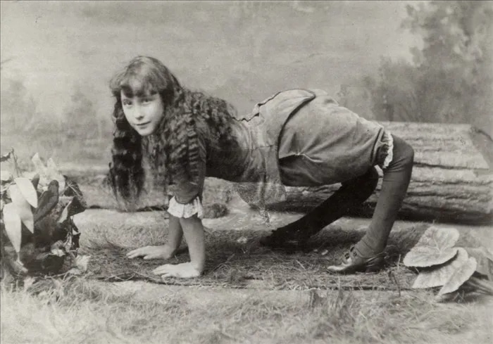 Ella harper: la "ragazza cammello" affetta da genu recurvatum, sfruttata e disumanizzata per compiacere il pubblico dei freak show - foto