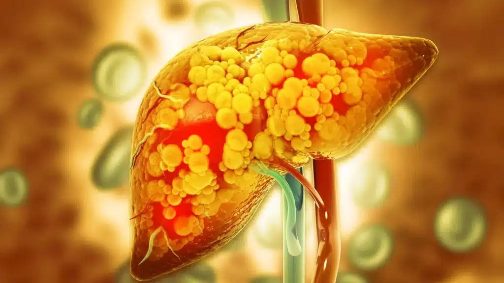 Scoperto il legame tra alcol e steatosi epatica: una proteina “chiave” nel mirino della mayo clinic %scoperto il legame tra alcol e steatosi epatica: una proteina “chiave” nel mirino della mayo cliniccount(title)% Scoperto il legame tra alcol e steatosi epatica: una proteina “chiave” nel mirino della mayo clinic