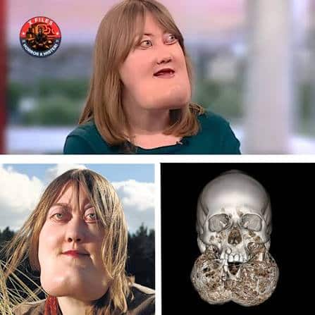 Victoria wright: un volto deturpato dal cherubismo, una vita di abusi e la voglia di aiutare gli altri - foto