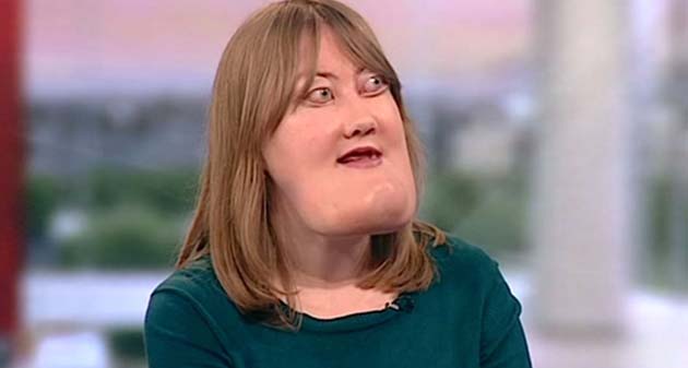 Victoria wright: un volto deturpato dal cherubismo, una vita di abusi e la voglia di aiutare gli altri - foto