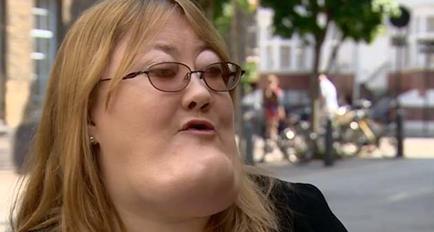 Victoria wright: un volto deturpato dal cherubismo, una vita di abusi e la voglia di aiutare gli altri - foto
