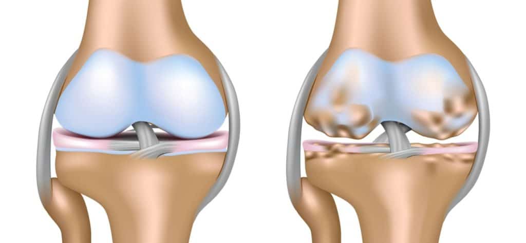 Artrosi al ginocchio: camminare, pedalare o nuotare è la terapia più efficace, secondo un nuovo studio %artrosi al ginocchio: camminare, pedalare o nuotare è la terapia più efficace, secondo un nuovo studiocount(title)% Artrosi al ginocchio: camminare, pedalare o nuotare è la terapia più efficace, secondo un nuovo studio
