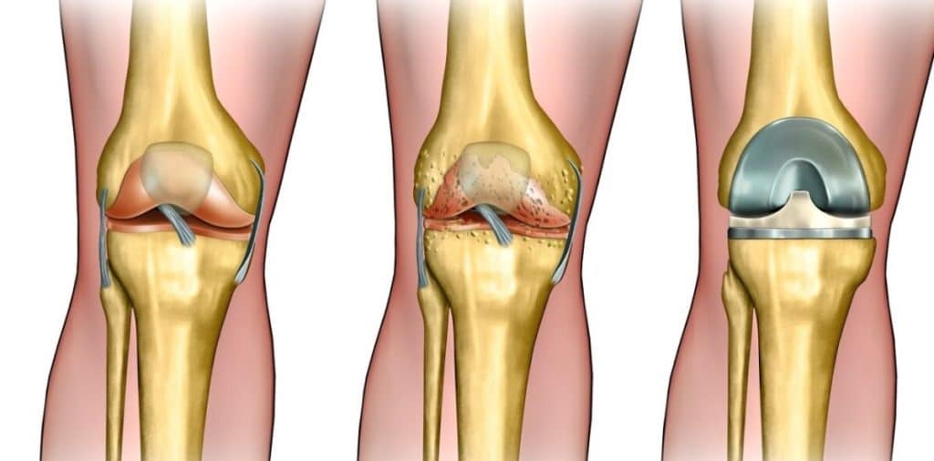 Artrosi al ginocchio: camminare, pedalare o nuotare è la terapia più efficace, secondo un nuovo studio %artrosi al ginocchio: camminare, pedalare o nuotare è la terapia più efficace, secondo un nuovo studiocount(title)% Artrosi al ginocchio: camminare, pedalare o nuotare è la terapia più efficace, secondo un nuovo studio