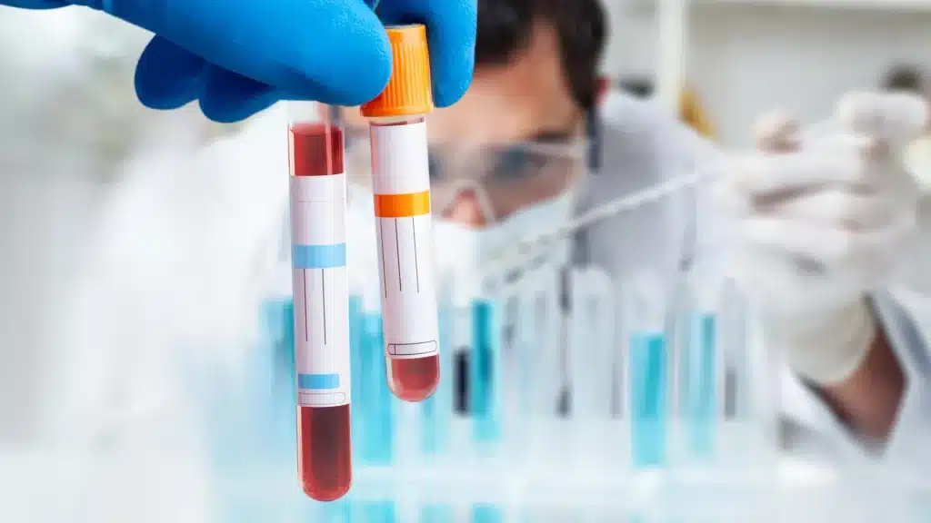 Scienziati sviluppano un test del sangue altamente accurato per diagnosticare la sindrome da fatica cronica (me/cfs) %scienziati sviluppano un test del sangue altamente accurato per diagnosticare la sindrome da fatica cronica (me/cfs)count(title)% Scienziati sviluppano un test del sangue altamente accurato per diagnosticare la sindrome da fatica cronica (me/cfs)