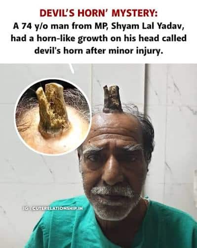 Shyam lal yadav: l'agricoltore indiano marchiato dal corno del diavolo -foto