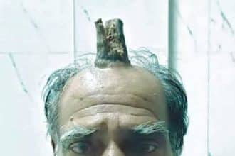 Shyam lal yadav: l'agricoltore indiano marchiato dal corno del diavolo -foto