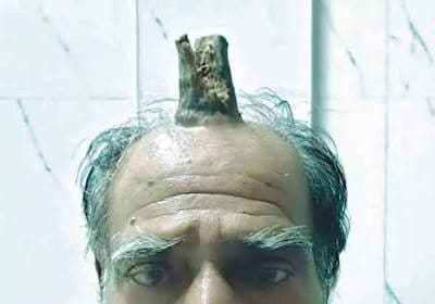 Shyam lal yadav: l'agricoltore indiano marchiato dal corno del diavolo -foto