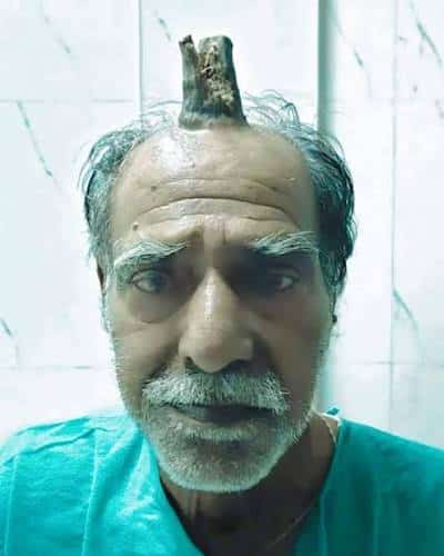 Shyam lal yadav: l'agricoltore indiano marchiato dal corno del diavolo -foto