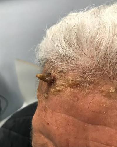 Shyam lal yadav: l'agricoltore indiano marchiato dal corno del diavolo -foto