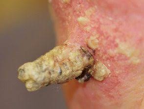 Shyam lal yadav: l'agricoltore indiano marchiato dal corno del diavolo -foto