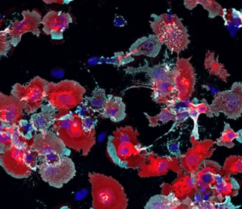 Alzheimer: scoperto un possibile collegamento diretto tra infiammazione e perdita di memoria