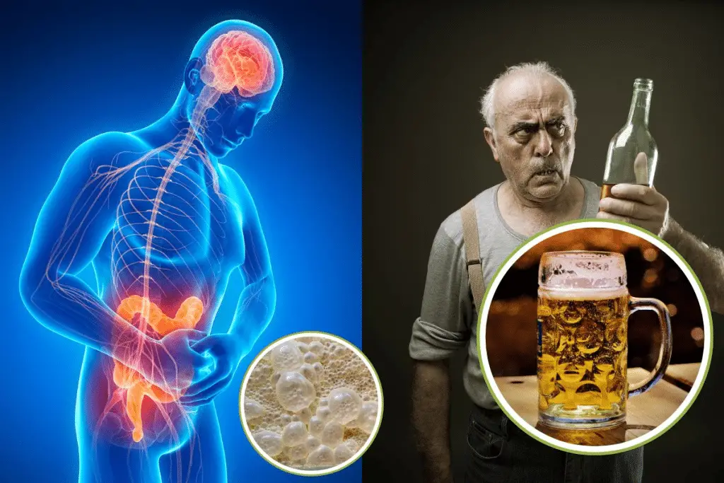 Sindrome dell’auto-birrificazione: scoperti i batteri che producono alcol nel nostro intestino