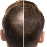 Un rimedio della medicina tradizionale cinese sotto la lente della scienza: nuove prospettive contro l’alopecia androgenetica %un rimedio della medicina tradizionale cinese sotto la lente della scienza: nuove prospettive contro l’alopecia androgeneticacount(title)% Un rimedio della medicina tradizionale cinese sotto la lente della scienza: nuove prospettive contro l’alopecia androgenetica