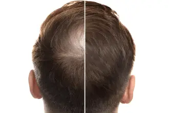Alopecia androgenetica