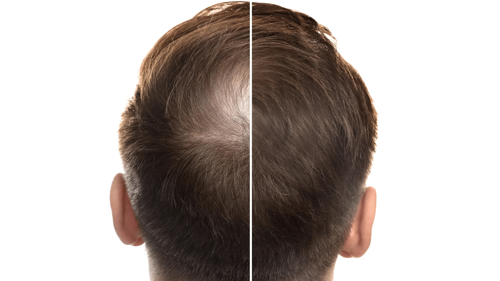 Alopecia androgenetica