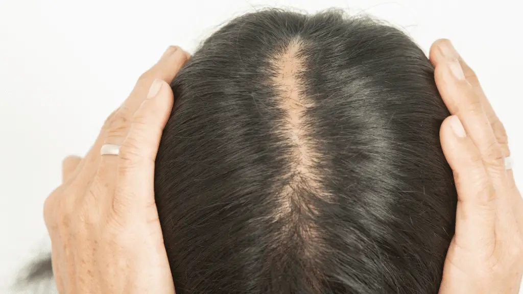 Un rimedio della medicina tradizionale cinese sotto la lente della scienza: nuove prospettive contro l’alopecia androgenetica