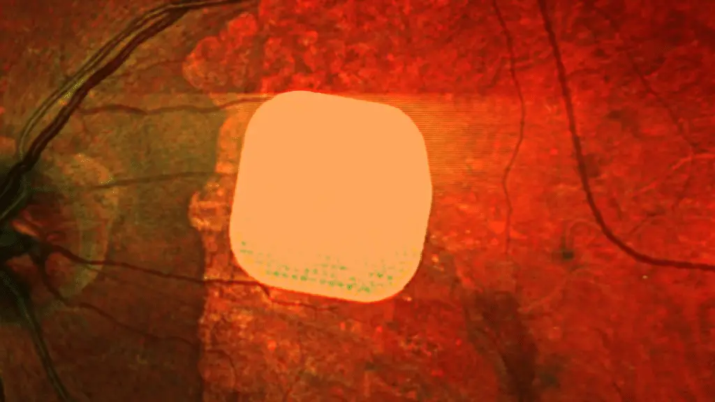 Un micro-impianto wireless ridà la vista centrale ai pazienti con degenerazione maculare