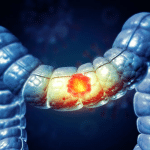 Ferroptosi contro i tumori: cosa mostra il primo trial con cnsi-fe?